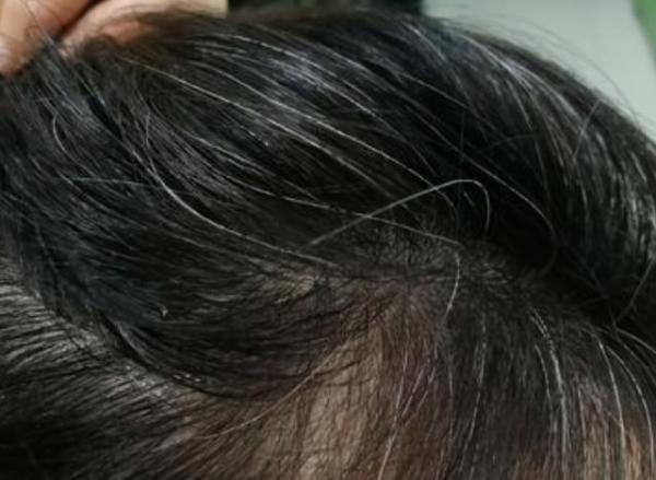 孩子头上有白头发怎么回事