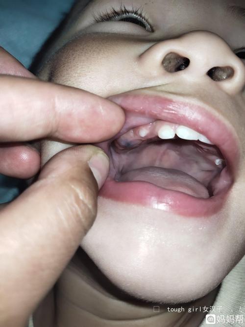 小孩子牙龈发炎怎么办