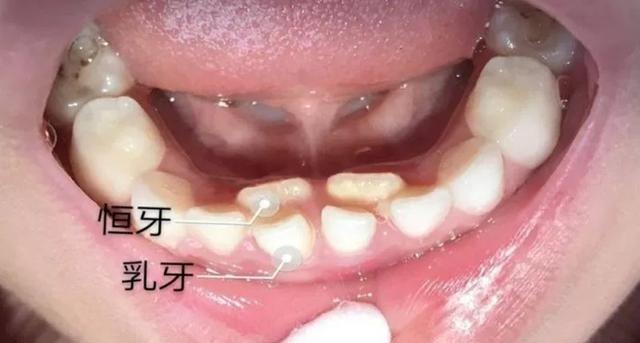 小孩子双排牙怎么办