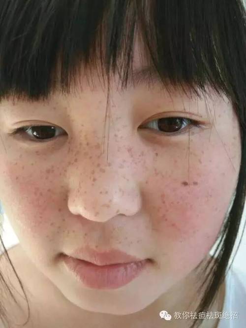 孩子脸上长斑怎么办