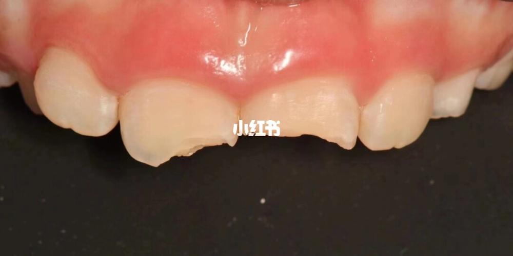 孩子门牙磕松了怎么办