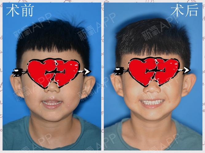 孩子牙齿地包天怎么办