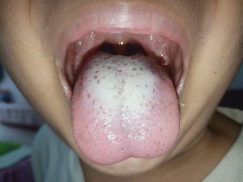 孩子舌苔发黑怎么回事