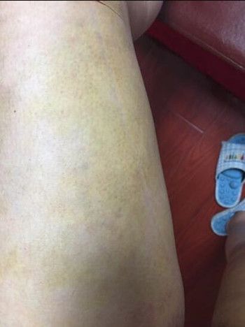 运动后右腿大腿面肿了