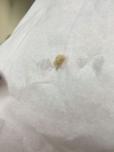 喉咙里有点东西总咳不完