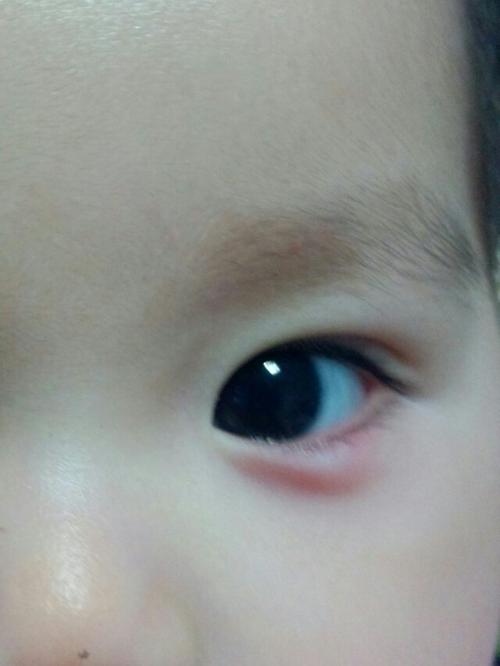 孩子眼睛突然肿了怎么回事