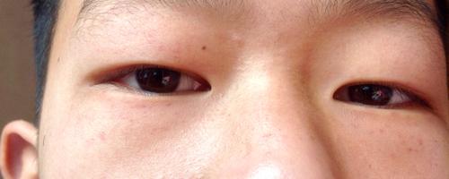 孩子眼袋发红怎么回事