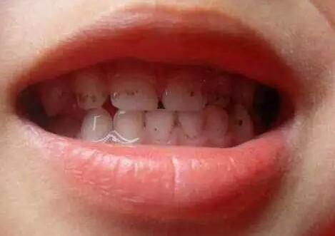 孩子牙齿色素沉着怎么去除