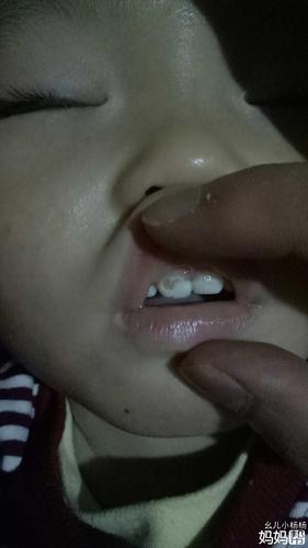小孩子牙齿有洞怎么办