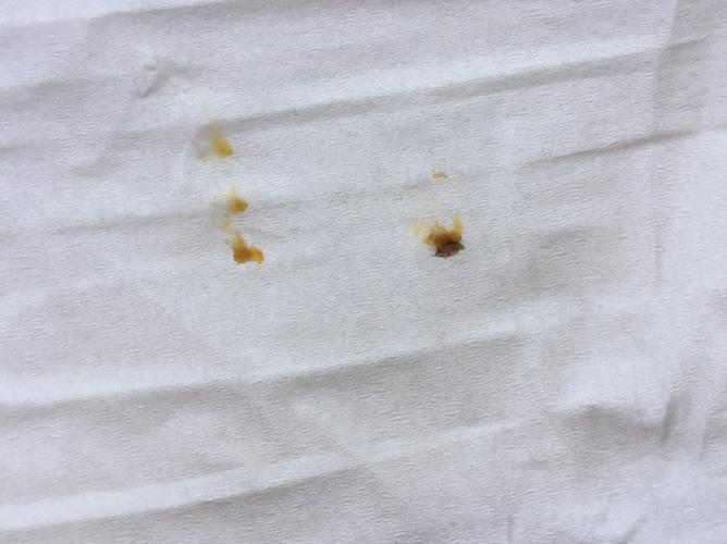 孩子耳朵里有硬耳屎怎么办