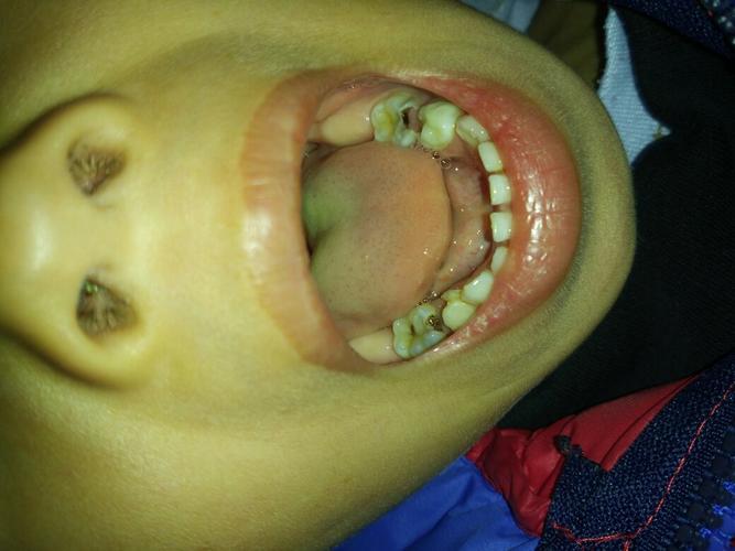 孩子换牙牙疼怎么办