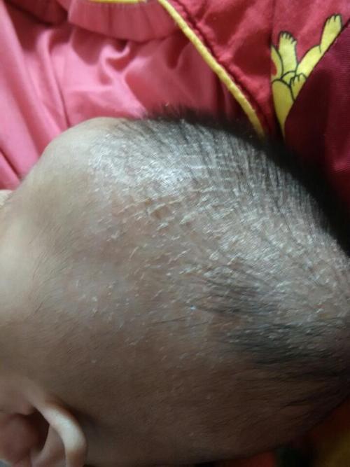 小孩子长头皮屑怎么办
