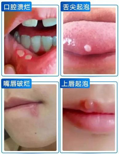 孩子嘴巴长溃疡怎么办