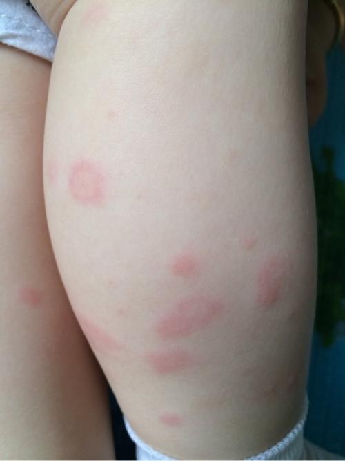 孩子长荨麻疹怎么办