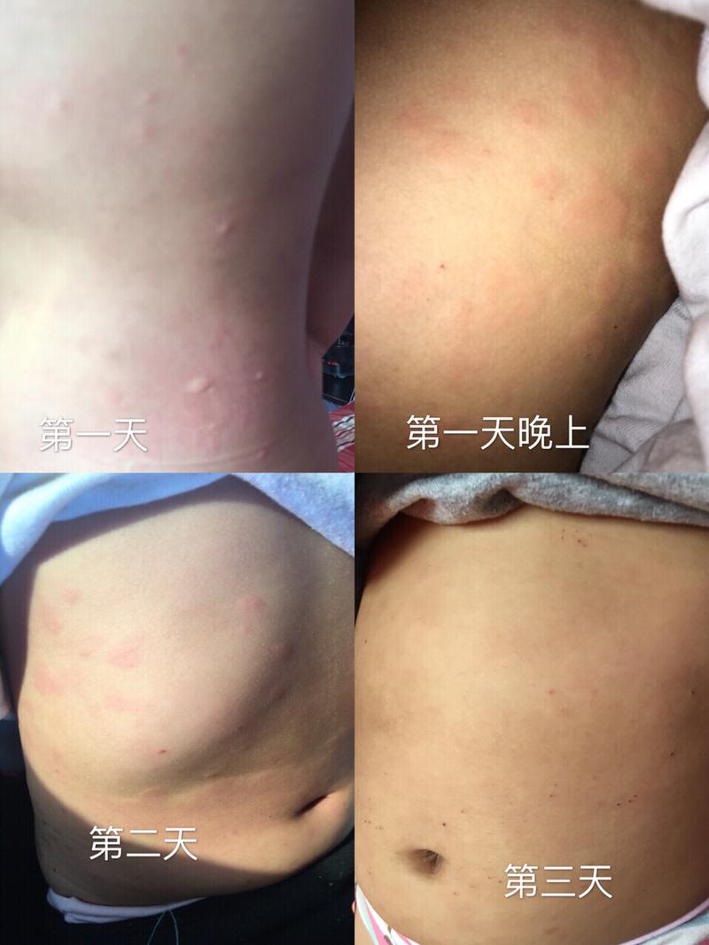 小孩子蛋白质过敏怎么办