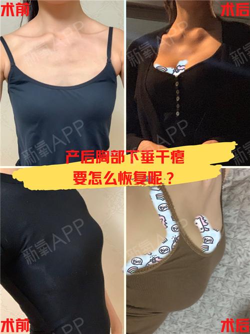 生完孩子胸下垂怎么办
