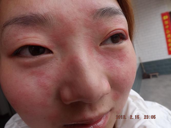 孩子脸过敏红肿痒怎么办
