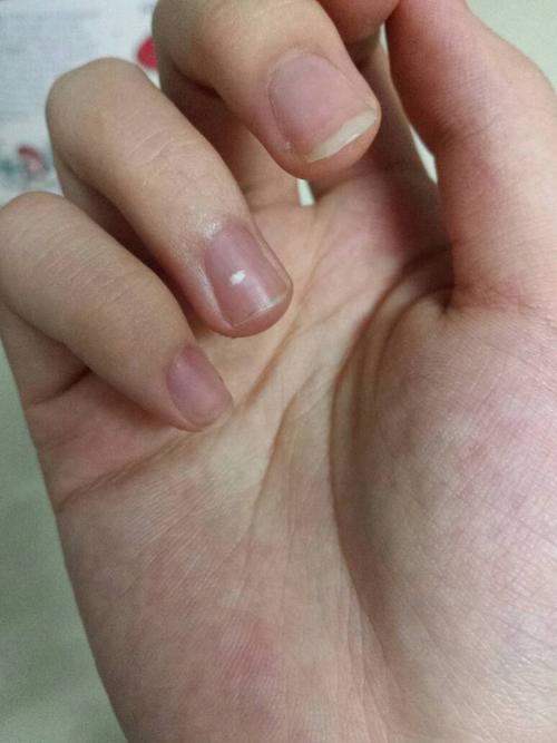 孩子手指甲有白点怎么回事