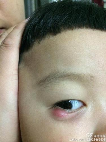 孩子起针眼了怎么办