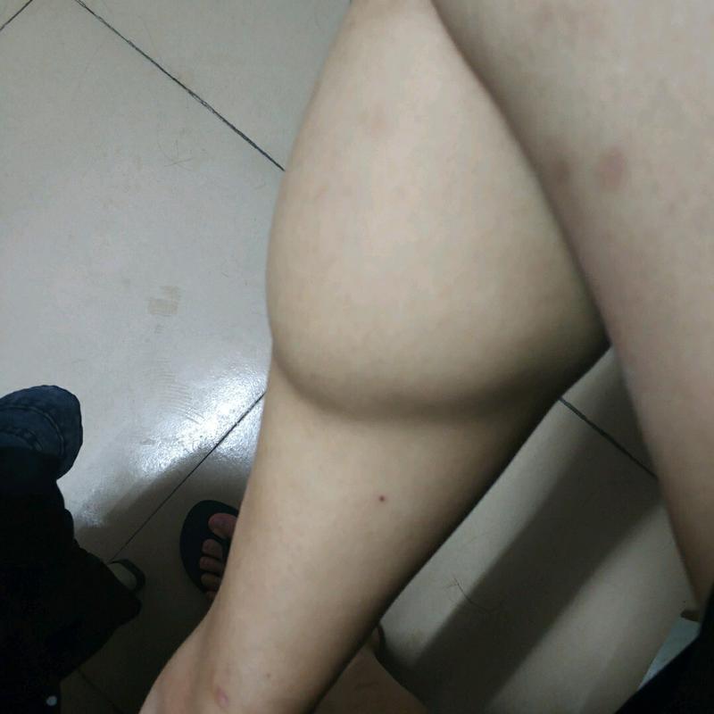 不运动 大腿肿