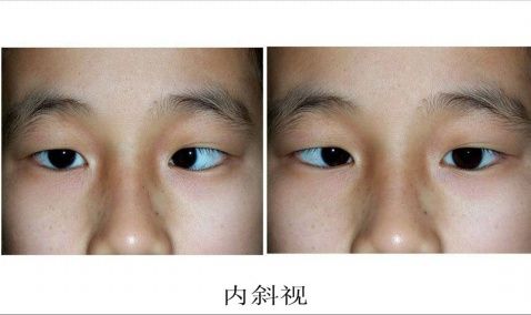 孩子斜视怎么矫正