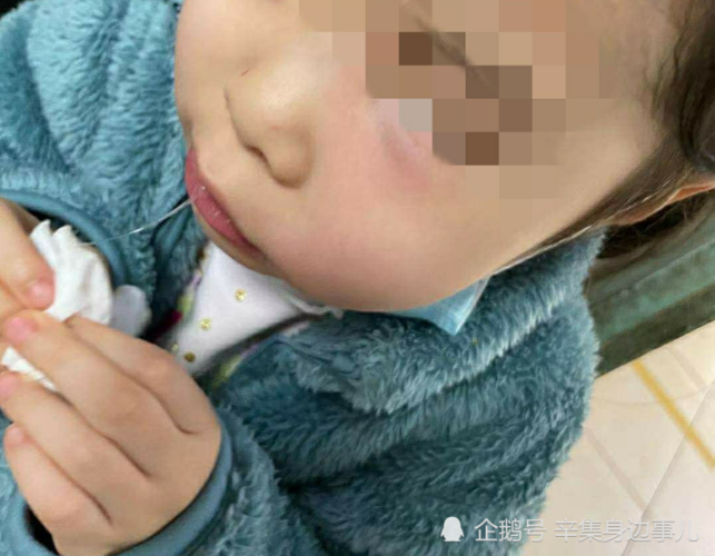 孩子牙疼脸肿了怎么办