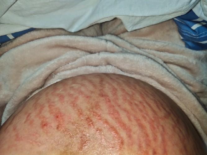 生完孩子妊娠纹怎么消除