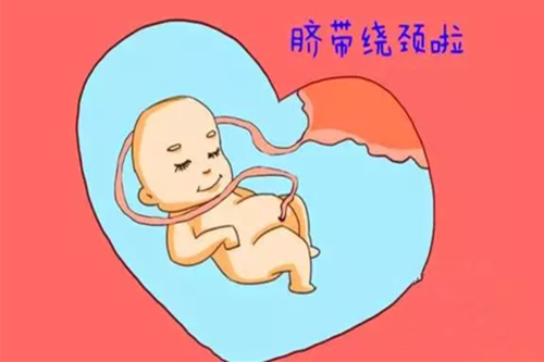 孩子绕颈一圈怎么办