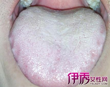 孩子舌苔发白怎么回事