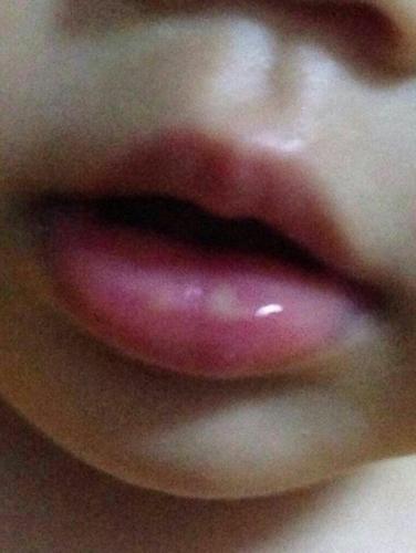小孩子嘴巴溃疡怎么办