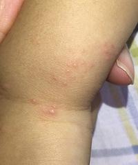 孩子起疹子怎么办