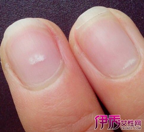 孩子指甲上有白点怎么回事