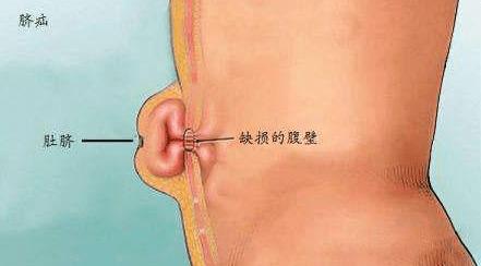 孩子肚脐眼疼是怎么回事