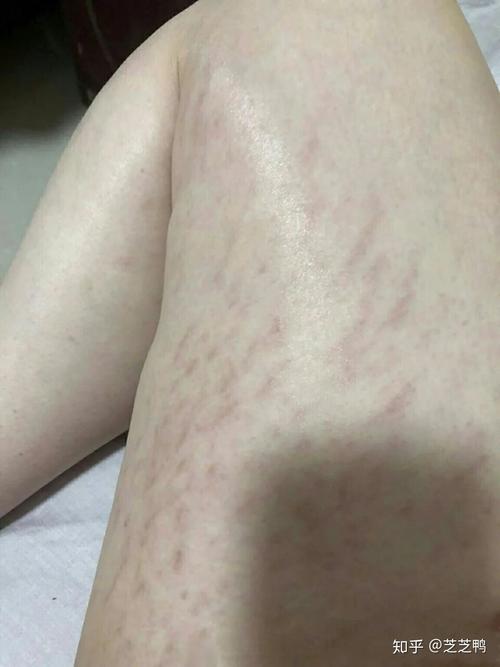 肥胖纹整样运动消出