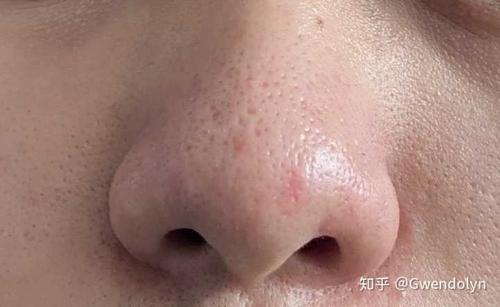 小孩子鼻子有黑头怎么办