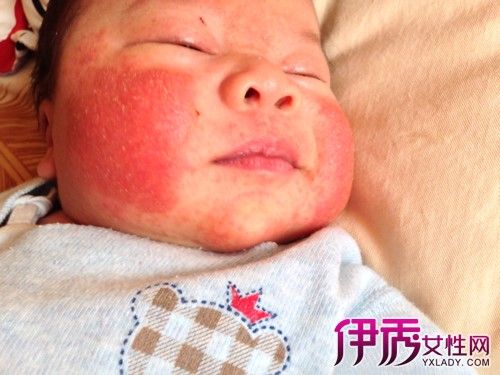孩子有湿疹怎么办