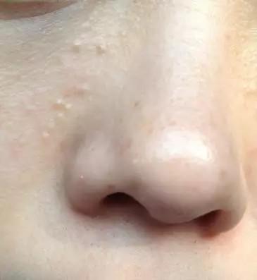 小孩子脂肪粒怎么去除