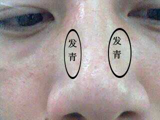 孩子鼻梁发青怎么回事