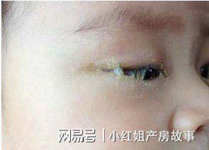 孩子眼屎多是怎么回事