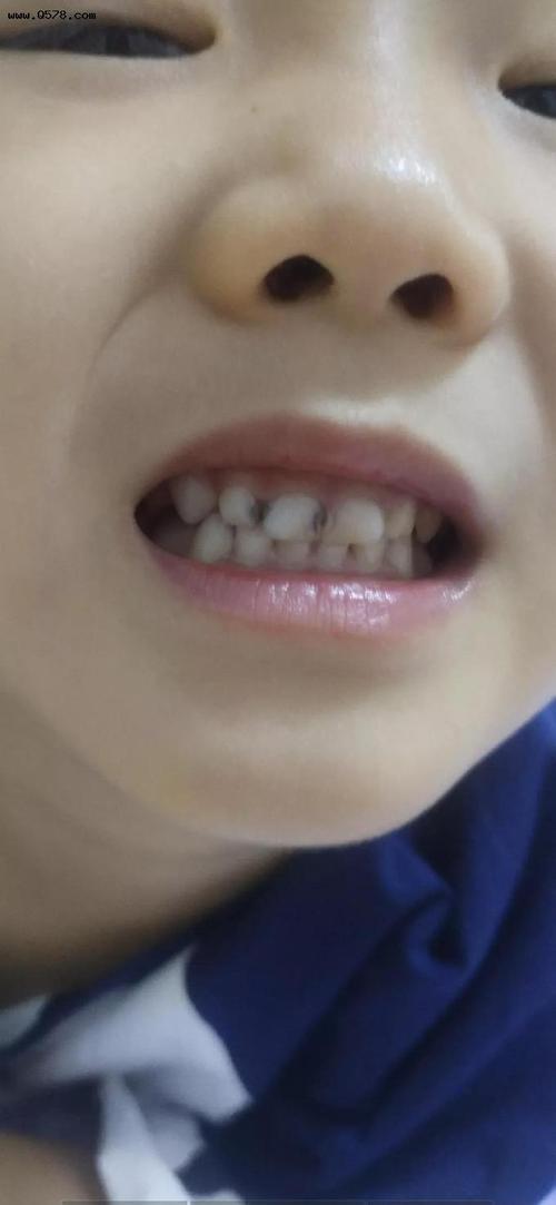 孩子牙齿痛怎么办