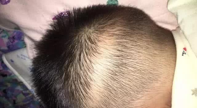 孩子枕秃怎么办