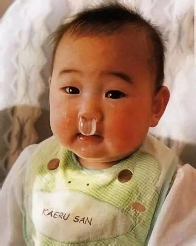 小孩子有点流鼻涕怎么办