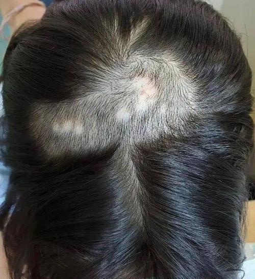 小孩子掉头发是怎么回事