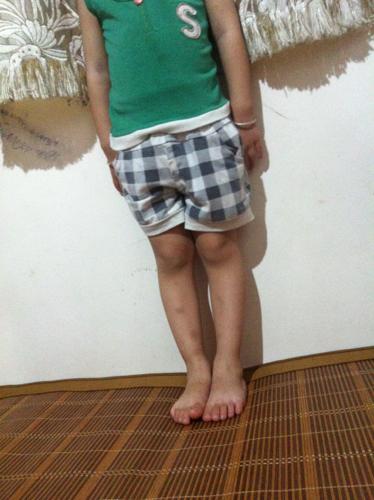 孩子罗圈腿怎么矫正