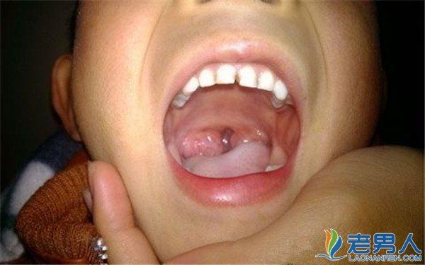 孩子老是扁桃体发炎怎么办