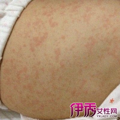 孩子发烧出疹子怎么办