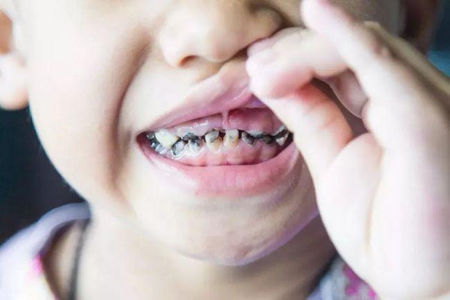 小孩子蛀牙疼怎么办