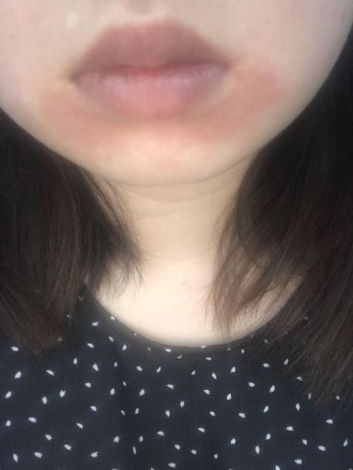 下巴突然痛痒红起东西