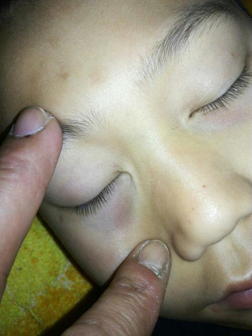 小孩子有眼袋怎么办