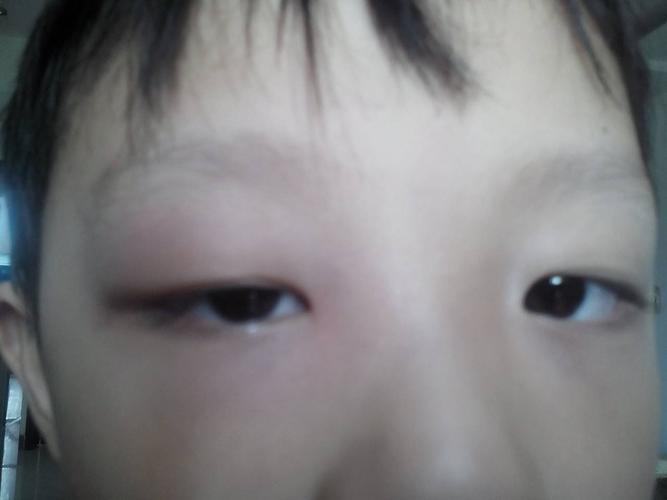小孩子眼睛痒怎么回事